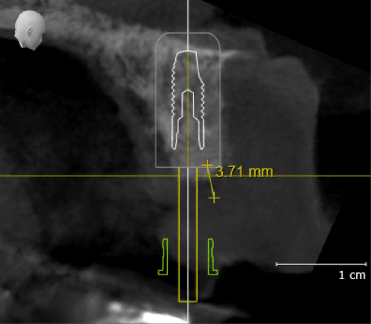 PL_VO1_SICAT_Implant-Implant-Aligned-Cross-Sectional_20260603_162350_2026-01-19_15_09