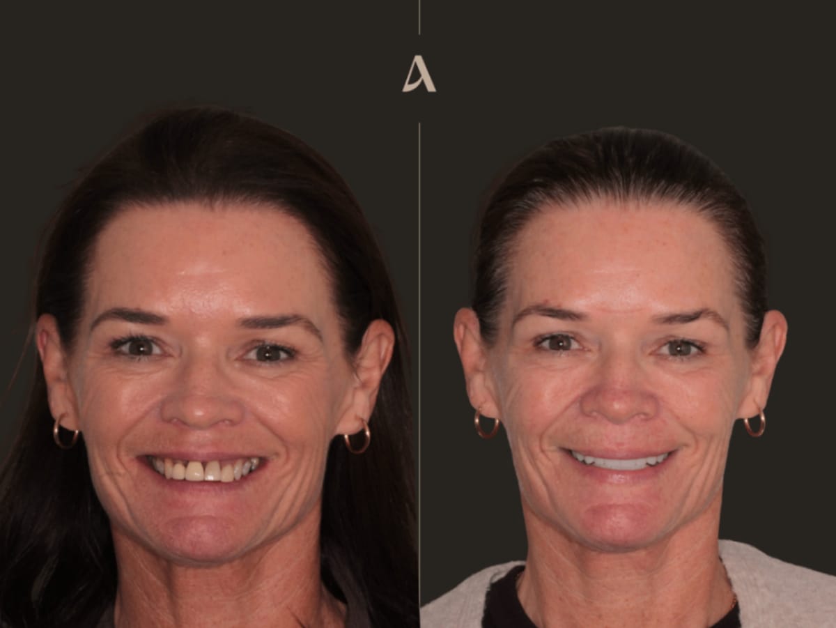 Treatment Implants, Oral Rehabilitation - Total Procedure Time 12 months