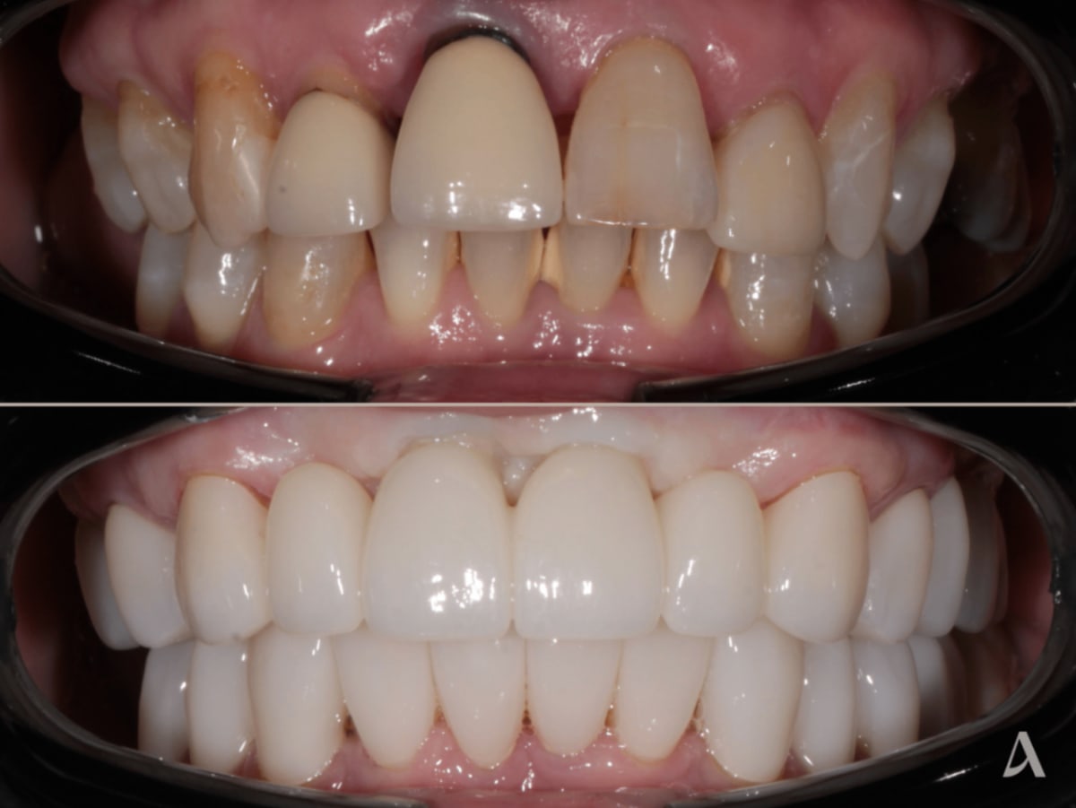 Treatment Zirconia Veneers  Complex Rehabilitation  Crown & BridgeImplants - Total Procedure Time 12 months