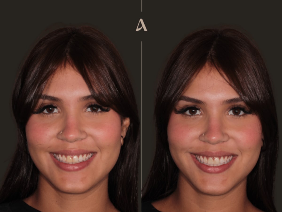 Before and after a single CEREC porcelain crown on an upper front tooth at ArtSmiles, Southport