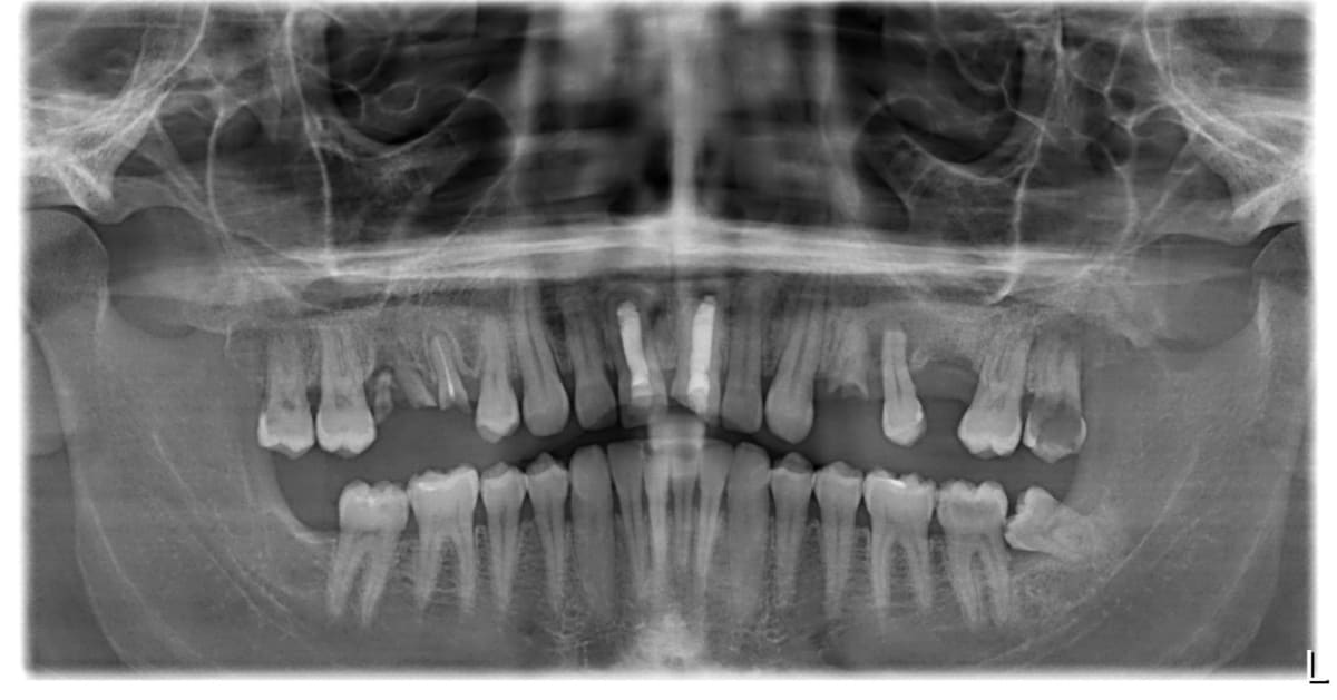 Panoramic X-ray before treatment showing missing upper back teeth and a failing root canal at the front