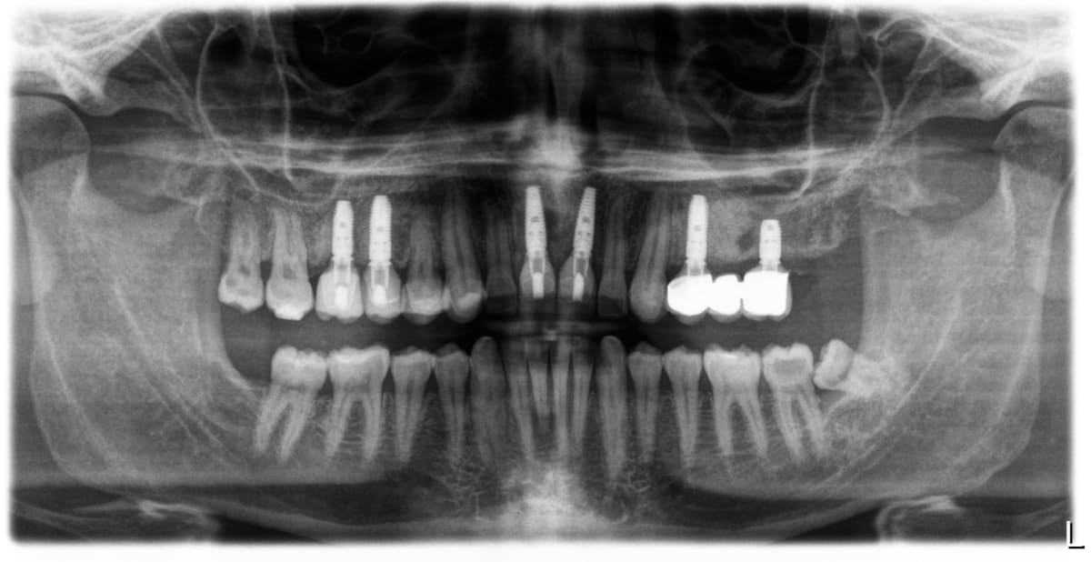 Panoramic X-ray showing six dental implants placed across the upper arch after bone grafting