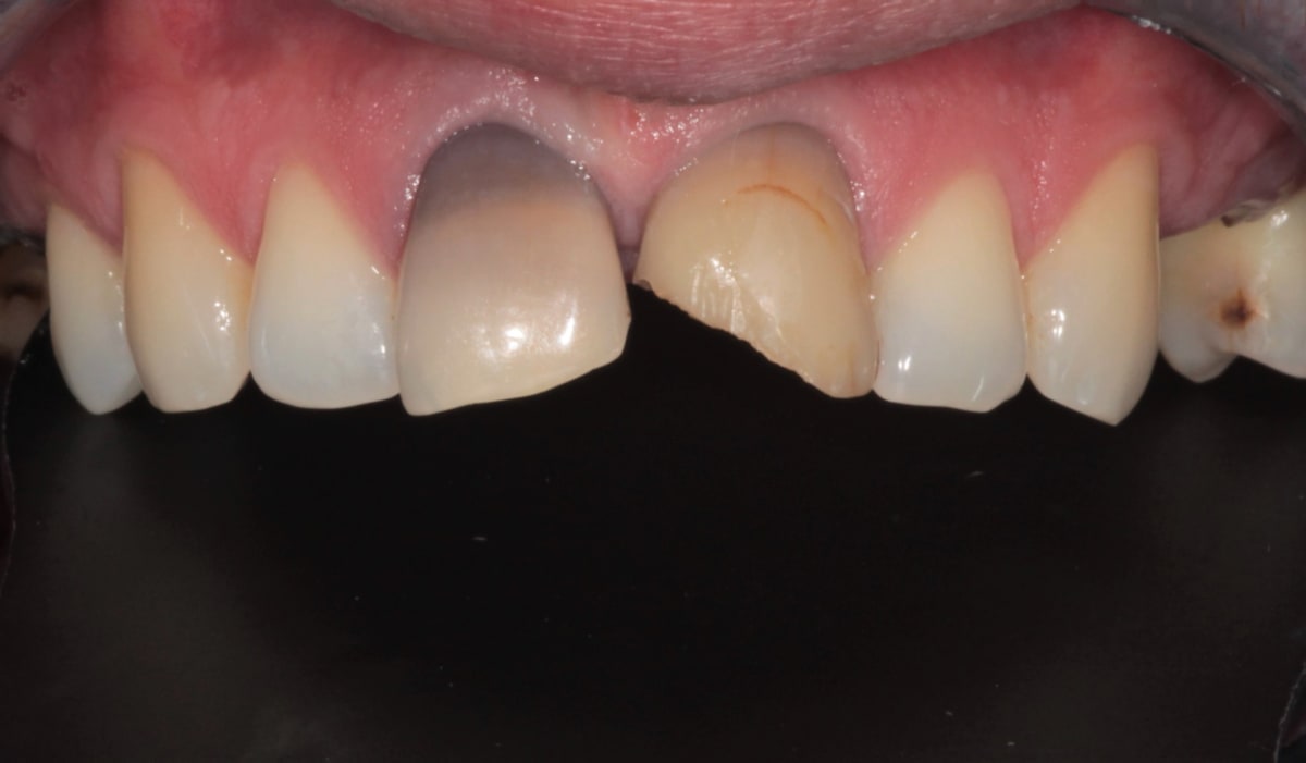 Retracted view of upper front teeth before treatment showing a darkened root-treated tooth and worn edges
