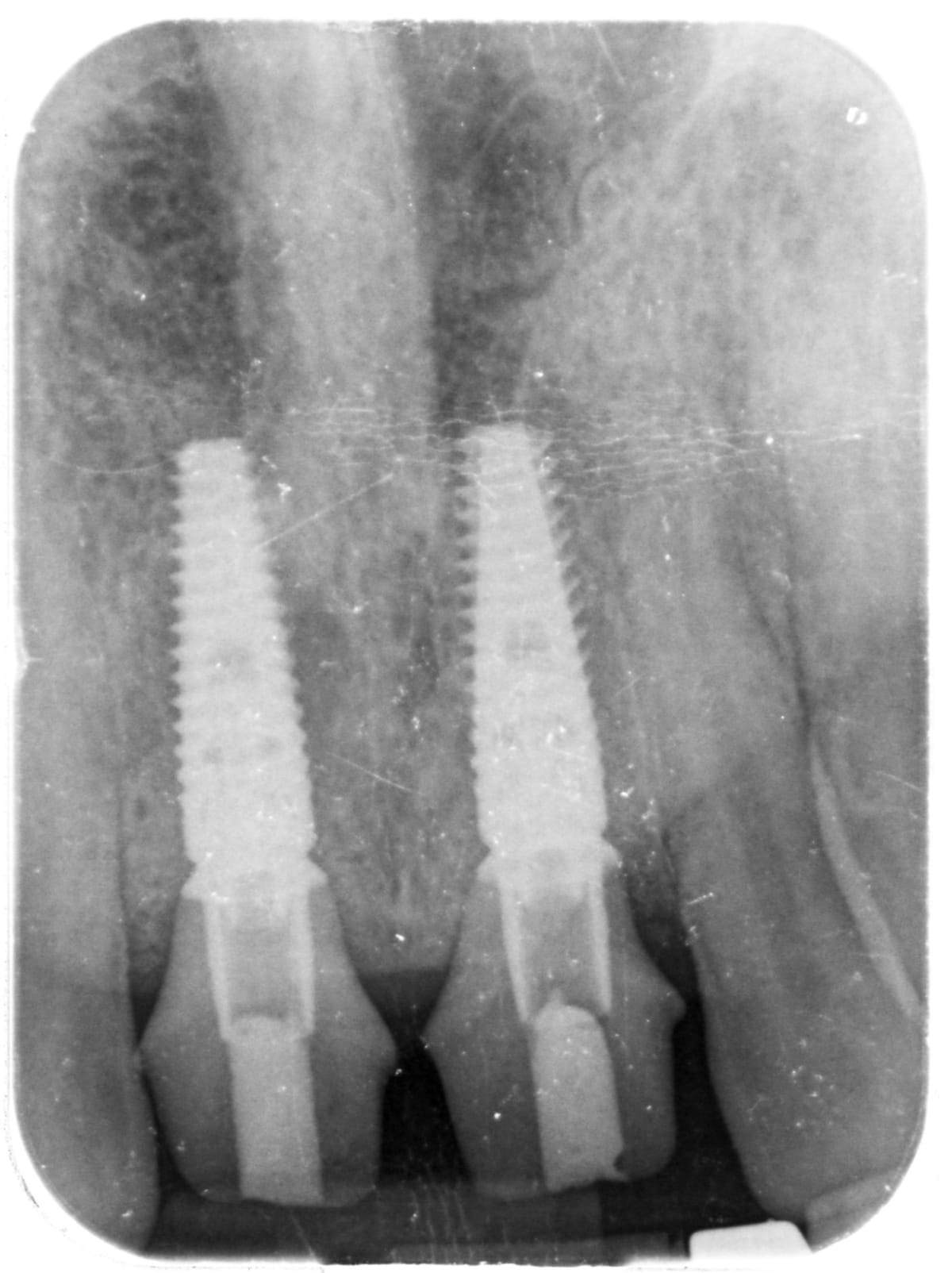 Periapical X-ray of two immediate dental implants placed in the upper front jaw