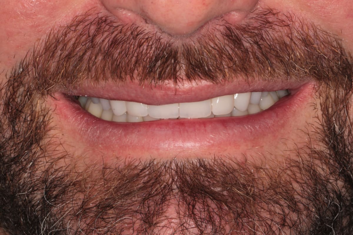 Patient's smile after upper full arch rehabilitation with implants, crowns and veneers