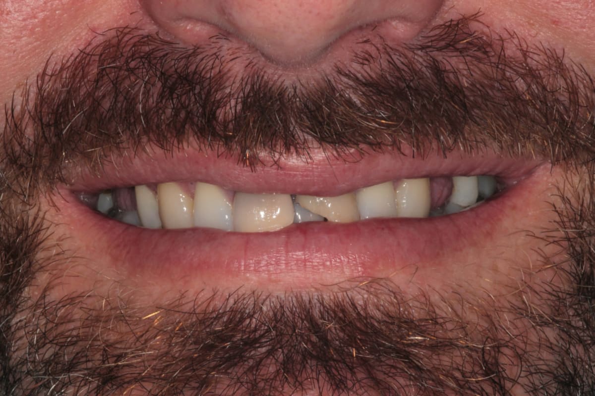 Close-up of patient's smile before treatment showing gaps and worn upper teeth