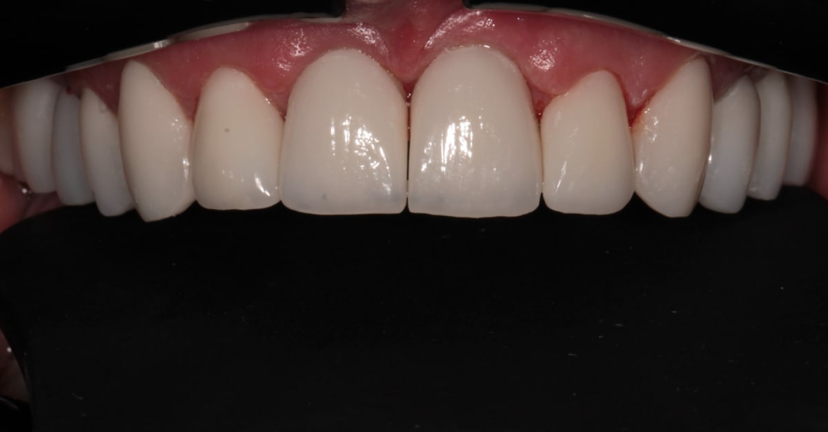 Retracted view of the completed upper crowns, veneers and implant bridge