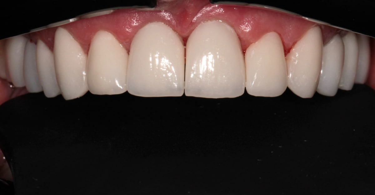 Upper front teeth after treatment, retracted view for the five year comparison