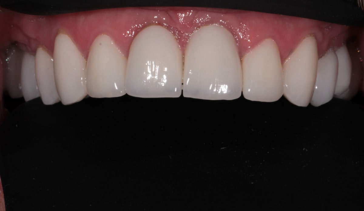 Upper front restorations at the five year review with healthy gum tissue and no decay