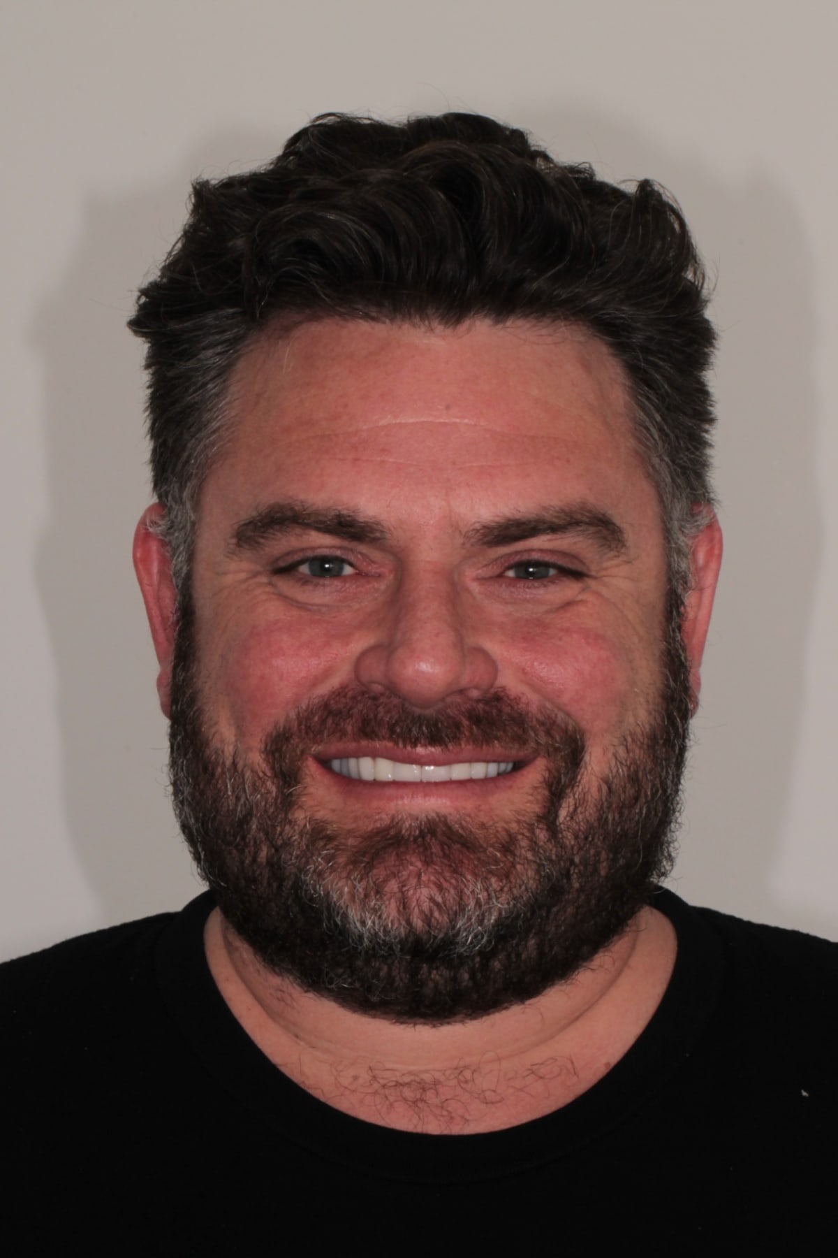 Full face portrait of the patient smiling at the five year review