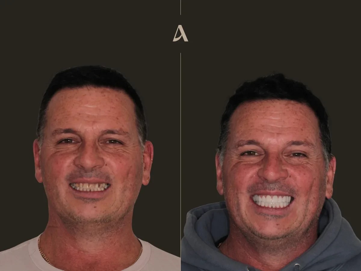 Male patient front facing before and after full mouth rehabilitation with zirconia veneers, crowns and bridges at an increased vertical dimension
