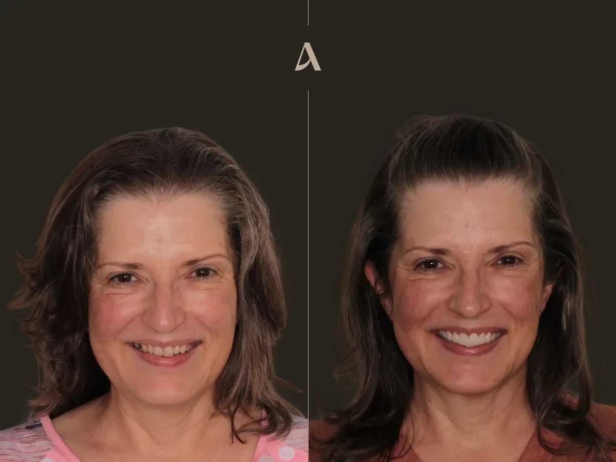 Female patient front facing before and after upper veneers and bridge with a lower implant and lower veneers at an increased vertical dimension