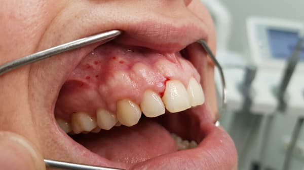 Oral Manifestations of Cardiac Disease