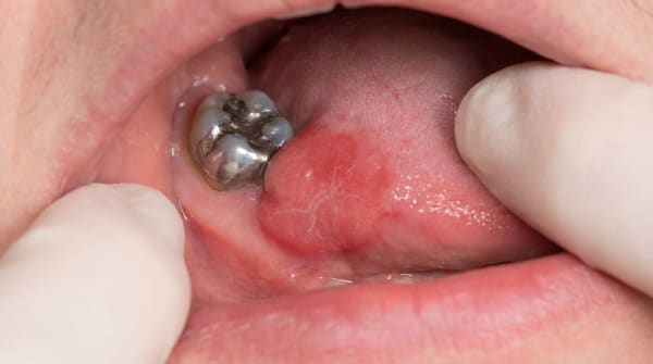 Contact Stomatitis and Oral Allergies — Why Your Mouth Reacts to Toothpaste, Gum or Dental Materials