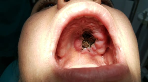 Deep Fungal Infections of the Mouth