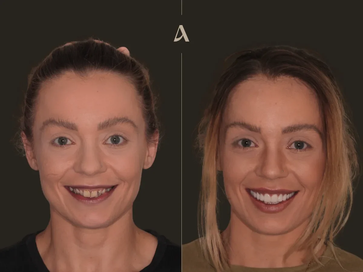 How a Full Mouth Restoration Reversed Years of Grinding Damage