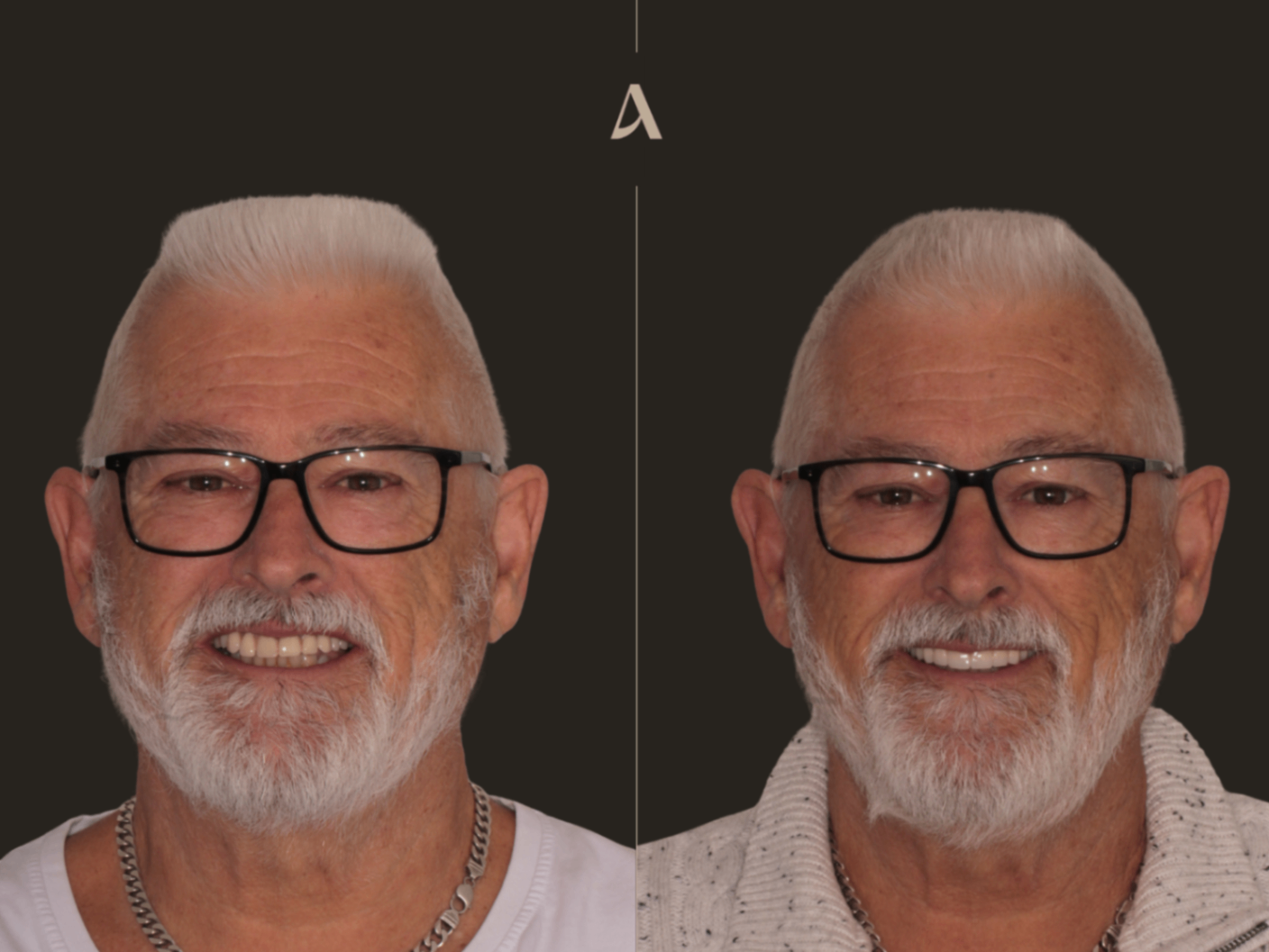 Clinical Case: Replacing a Fractured Acrylic All on X Bridge with Zirconia