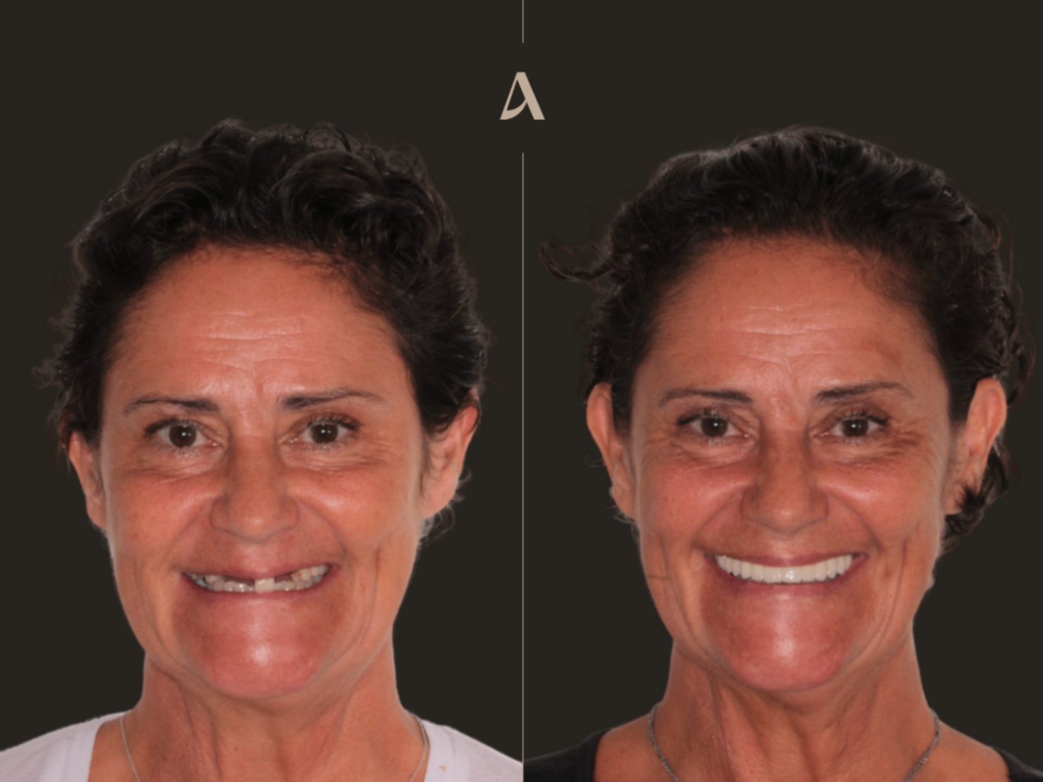 Upper jaw before implant placement, showing decayed anterior tooth roots and a shade-matched trial crown held up to the gap.