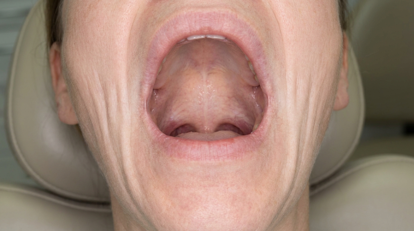Illustration of the inside of both cheeks showing pale, marbled mucosa with vertical fibrous bands and restricted mouth opening, characteristic of advanced oral submucous fibrosis.