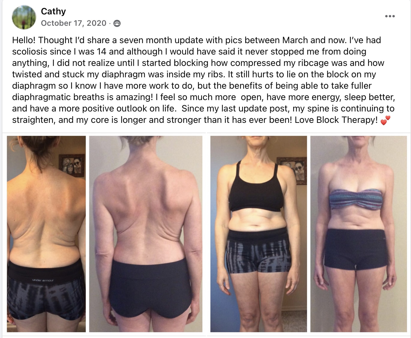 Cathy - Scoliosis copy
