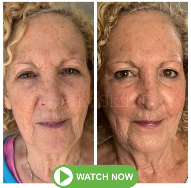 Facial-Flow-Before-After-A