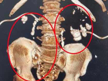 Более двадцати камней в почках у мужчины удалили врачи в Жуковской больнице