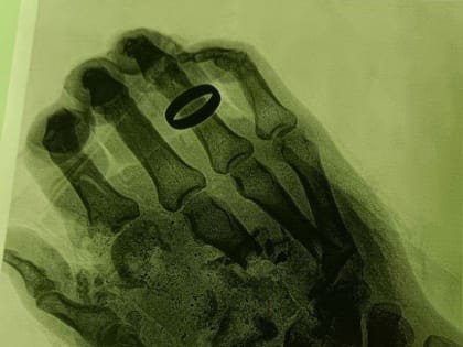 В Орехово-Зуеве врачи восстановили человеку кисть, которая была раздроблена взрывом газового баллона