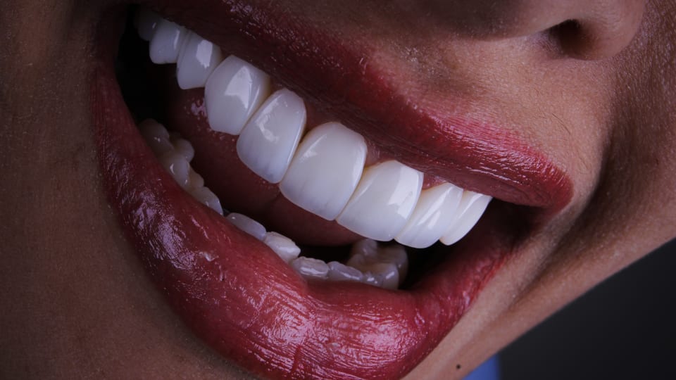composite bonding.JPG