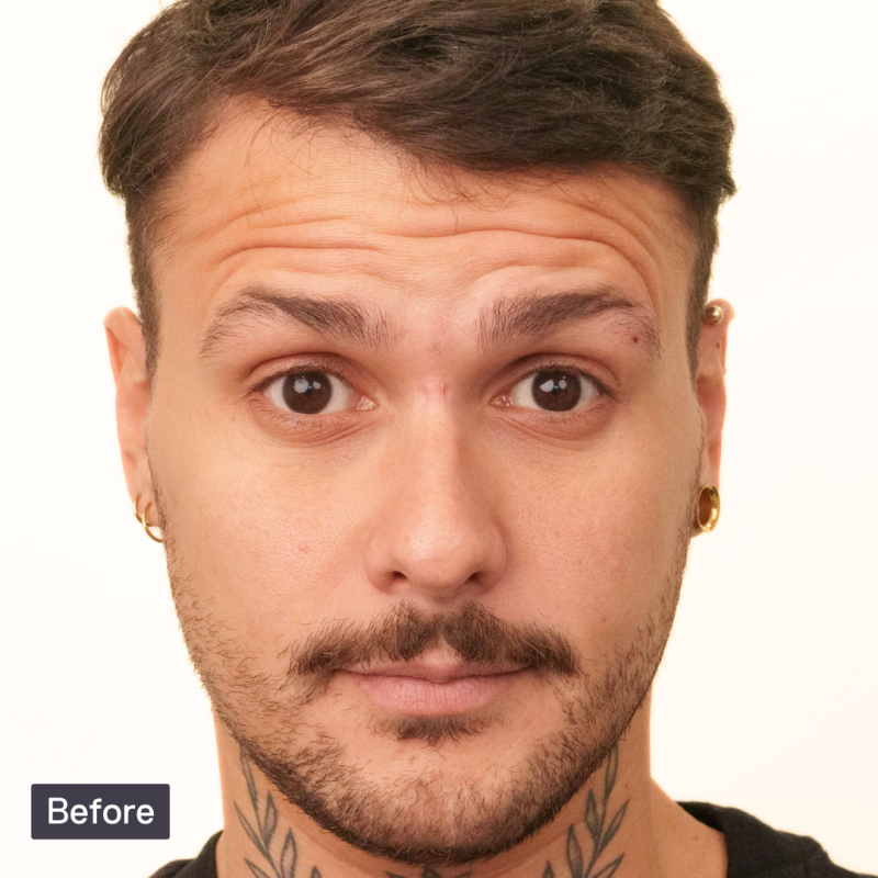 Man with raised eyebrows showing forehead wrinkles in a 'Before' cosmetic treatment photo.