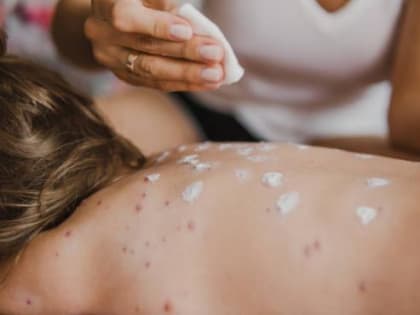 На Дону зарегистрировано 15 случаев кори с начала года