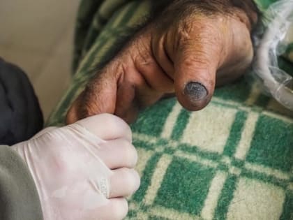 Московские стоматологи вылечили зубы двум шимпанзе из ростовского зоопарка