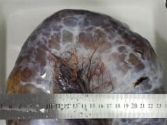 Паталогоанатомы Бурятии показали огромную кисту яичника