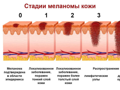 Меланома