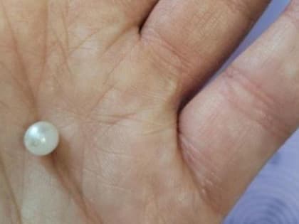 В Бурятии врач спасла зрение девочке, которая затолкала себе бусинку глаз