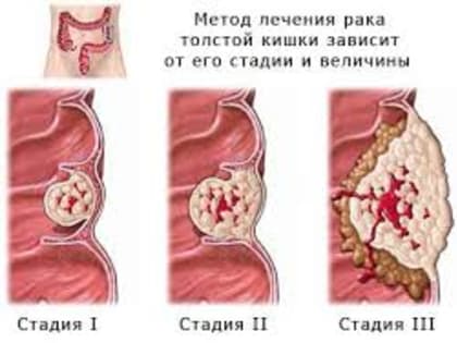 Колоректальный рак – это рак толстой кишки.