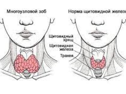 25 МАЯ - ВСЕМИРНЫЙ ДЕНЬ ЗАБОЛЕВАНИЙ ЩИТОВИДНОЙ ЖЕЛЕЗЫ
