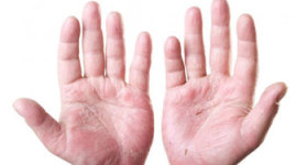 dermatitis-por-contacto-op_gmwfsx
