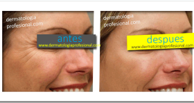 anti edad, arrugas, rejuvenecimiento, edad, lineas de expreson, disminuir lineas de expresion