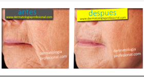anti edad, arrugas, rejuvenecimiento, edad, lineas de expreson, disminuir lineas de expresion