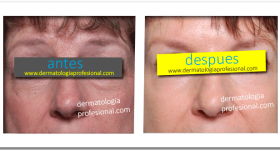 anti edad, arrugas, rejuvenecimiento, edad, lineas de expreson, disminuir lineas de expresion