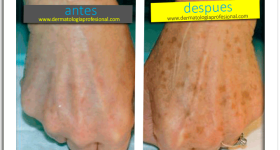 anti edad, arrugas, rejuvenecimiento, edad, lineas de expreson, disminuir lineas de expresion