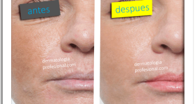 anti edad, arrugas, rejuvenecimiento, edad, lineas de expreson, disminuir lineas de expresion