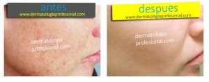 quitar manchas, manchas de acne, eliminar manchas