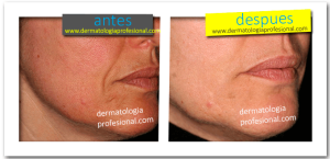 como quitar las ojeras, acido hialuronico, medicina estetica, lifting facial, arrugas en la cara, rejuvenecimiento, rejuvenece, como rejuvenecer la piel, tratamiento para las arrugas, tratamientos para las arrugas,