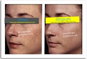 quitar manchas, manchas de acne, eliminar manchas