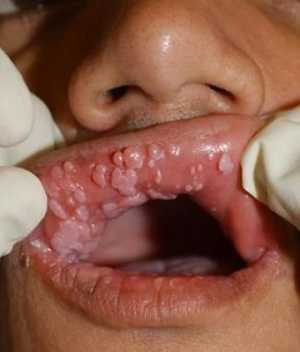 VPH, virus del papiloma humano