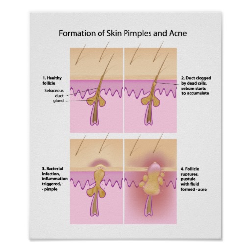 causas del acne