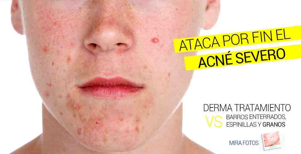 Tratamiento-para-Acne-y-Cicatrices-Severas-N_w4wexc