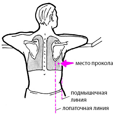 Прививка под лопатку картинки