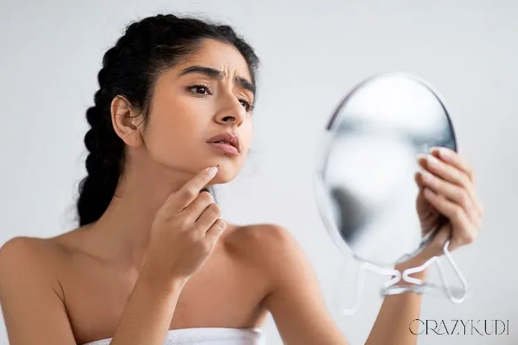 How Niacinamide Helps in Treating Acne: Benefits and Usage Tips